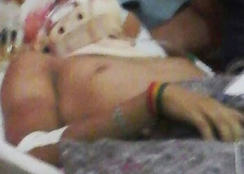 Adolescente teve um grave traumatismo craniano