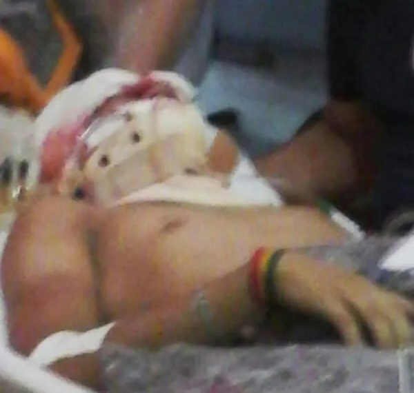 Adolescente teve um grave traumatismo craniano