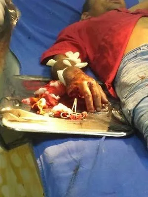 Adolescente decepa dedos de cunhado com terçado