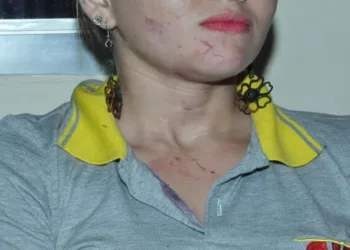 Após agressão, cobradora ficou com hematomas no rosto