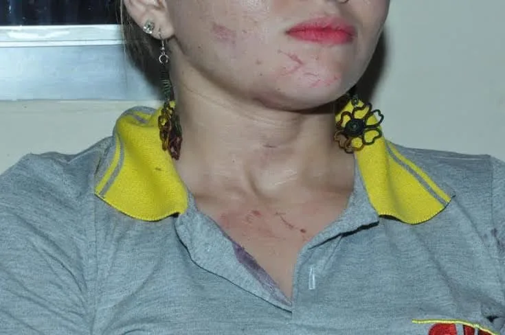 Após agressão, cobradora ficou com hematomas no rosto