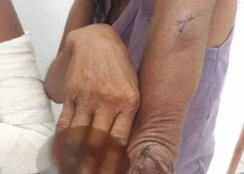 Mãe teve o dedo decepado e filha o braço quebrado por agressores(Foto/ Aldejane Pinto )