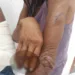 Mãe teve o dedo decepado e filha o braço quebrado por agressores(Foto/ Aldejane Pinto )