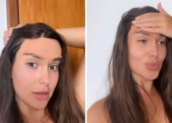 Thaiz Braz comenta pós-operatório para diminuir testa: "agonia"