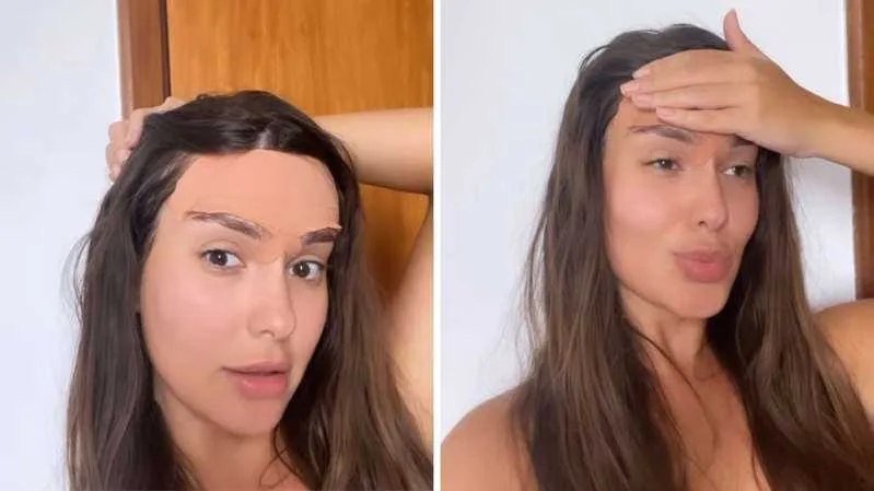 Thaiz Braz comenta pós-operatório para diminuir testa: "agonia"
