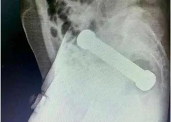 Médicos retiram peso de academia de 2 kg do reto de homem em Manaus