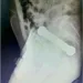Médicos retiram peso de academia de 2 kg do reto de homem em Manaus