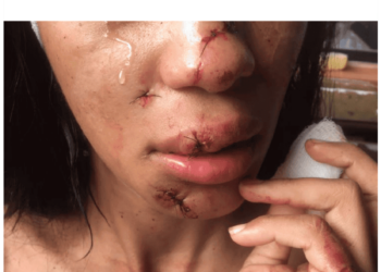 Jovem sofre graves lesões na face após ser agredida a garrafadas por mulheres em Sena Madureira