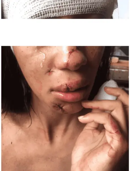 Jovem sofre graves lesões na face após ser agredida a garrafadas por mulheres em Sena Madureira