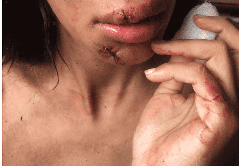 Jovem sofre graves lesões na face após ser agredida a garrafadas por mulheres em Sena Madureira