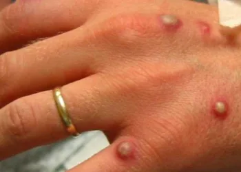 O que é, quais os sintomas e formas de prevenção da varíola dos macacos?