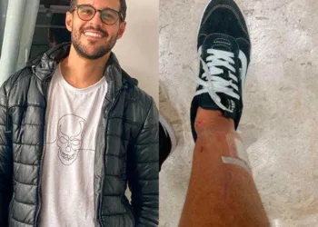 Rodrigo Mussi mostra como ficou a perna depois do acidente: Mais um dia de recuperação