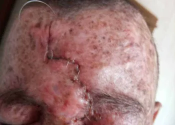 Isaque após uma cirurgia para remoção de tumor; Xeroderma pigmentoso.