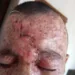 Isaque após uma cirurgia para remoção de tumor; Xeroderma pigmentoso.