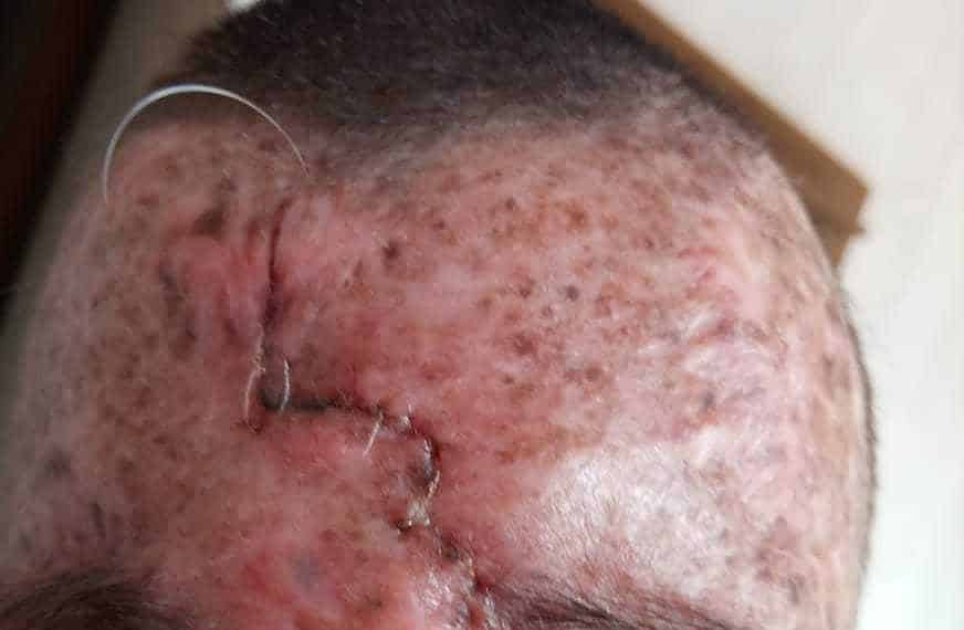 Isaque após uma cirurgia para remoção de tumor; Xeroderma pigmentoso.