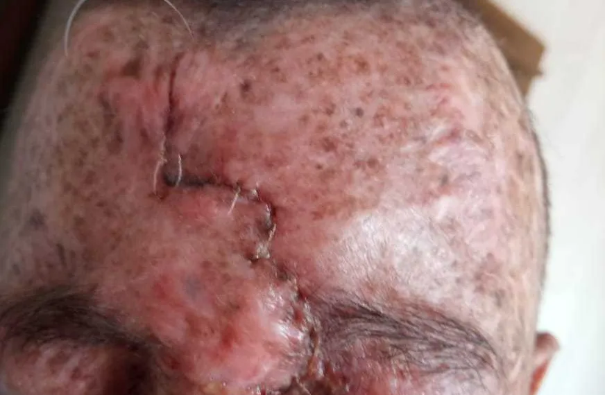 Isaque após uma cirurgia para remoção de tumor; Xeroderma pigmentoso.