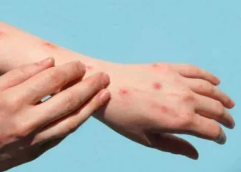 Monkeypox: Acre registra 14º caso suspeito da doença em mulher de 27 anos