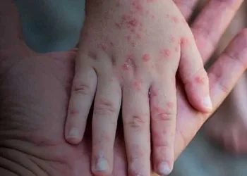 Monkeypox: Dois novos casos suspeitos são notificados no município de Cruzeiro do Sul