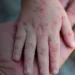 Monkeypox: Dois novos casos suspeitos são notificados no município de Cruzeiro do Sul