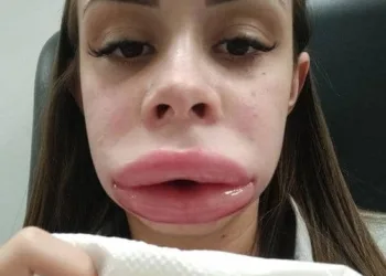 Jovem faz preenchimento labial e, após inchaço fora do comum, descobre doença rara