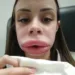 Jovem faz preenchimento labial e, após inchaço fora do comum, descobre doença rara