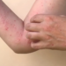 Sesacre descarta caso suspeito de monkeypox e notifica mais um em Rio Branco