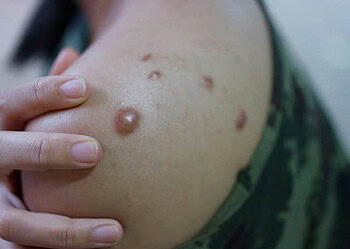 Sesacre notifica novo caso suspeito de monkeypox no Estado