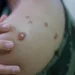 Sesacre notifica novo caso suspeito de monkeypox no Estado