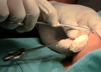 O procedimento é oferecido pelo Sistema Único de Saúde (SUS). Foto: internet