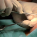 O procedimento é oferecido pelo Sistema Único de Saúde (SUS). Foto: internet
