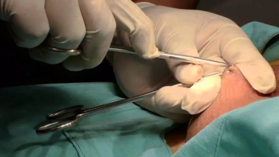 O procedimento é oferecido pelo Sistema Único de Saúde (SUS). Foto: internet