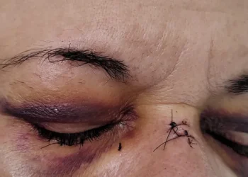 Mototaxista precisou pegar pontos no nariz e abaixo do olho direito após agressões de suspeito estupro — Foto: Aline Nascimento/g1