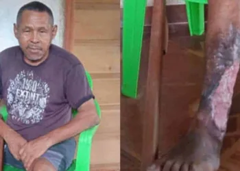 Ex-seringueiro que perdeu perna após picada de cobra pede ajuda para comprar cadeira de rodas