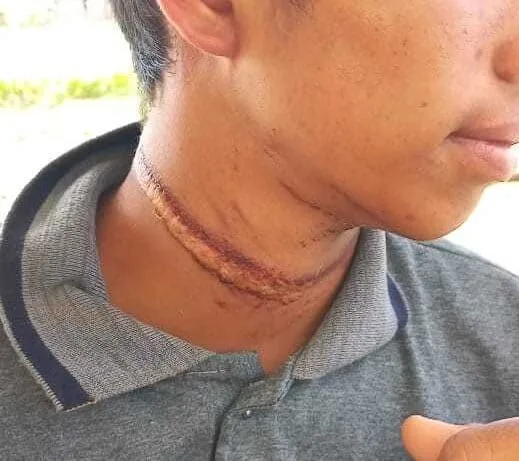 Adolescente quase é degolado ao tentar laçar vaca no Acre