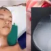Jovem fica com cartucho de espingarda alojado no crânio após tentar atirar em mucura