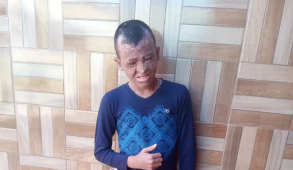 Isaque de Sousa, de 12 anos, foi diagnosticado com xeroderma pigmentoso com um ano de vida — Foto: g1 Ac