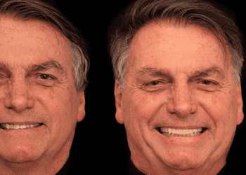 Antes e depois de Bolsonaro após harmonização facial
© Instagram, @rildolasmar