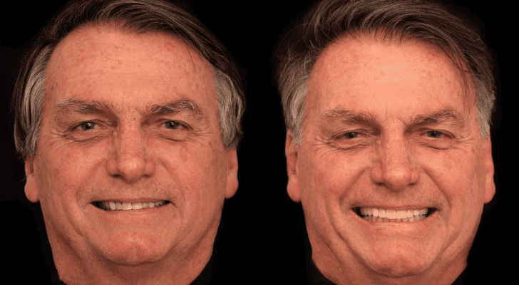 Antes e depois de Bolsonaro após harmonização facial
© Instagram, @rildolasmar