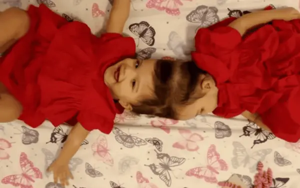 Gêmeas unidas pela cabeça são separadas em cirurgia de 25h e passam bem, diz hospital