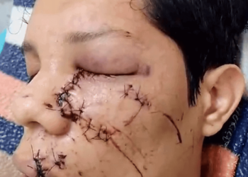 Após cirurgia de retirada do olho, jovem agredido por empresário permanece internado no PS
