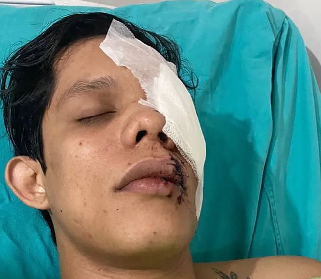 Jovem agredido copo no rosto perde a visão e vai passar por cirurgia de retirada do olho esquerdo