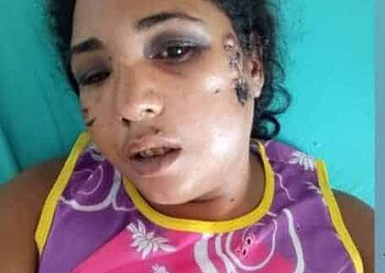 Família faz campanha para custear cirurgia de acreana atingida com tiro na cabeça pelo marido