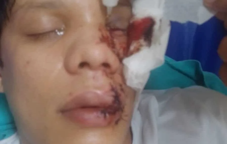 MPAC acompanha investigações sobre agressão de jovem que perdeu a visão ao ser atingido com copo