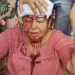 Idosa sofre ferimento na cabeça após cair em buraco na Benjamin Constant, Centro da Capital