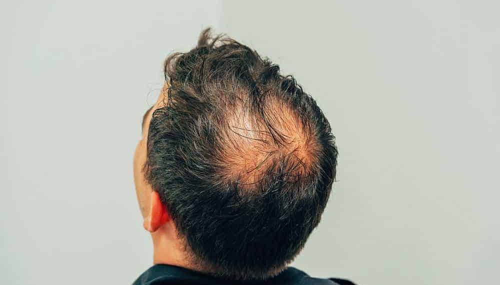 Novo remédio contra queda de cabelo é aprovado pela Anvisa