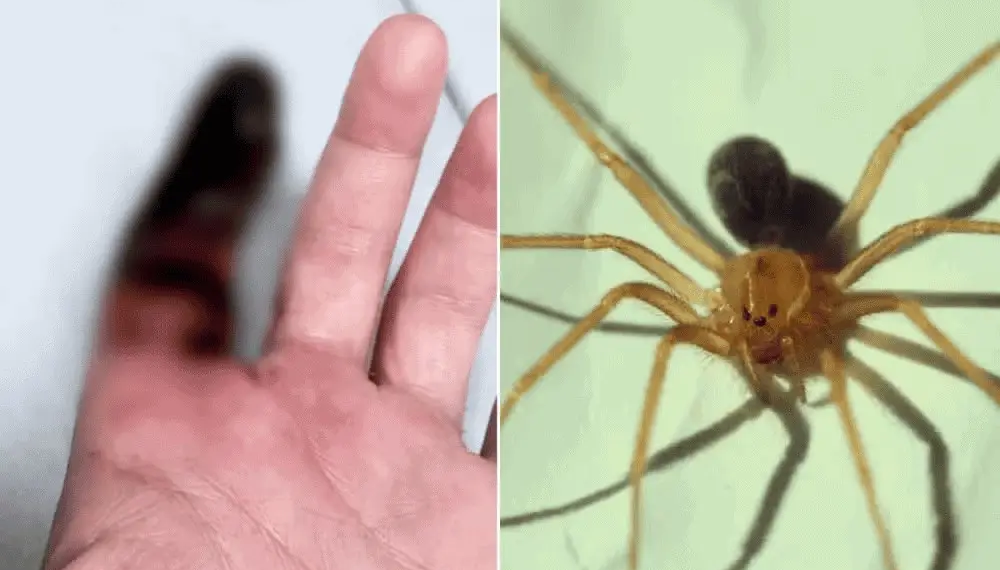 Homem picado por aranha venenosa enquanto dormia terá dedo amputado