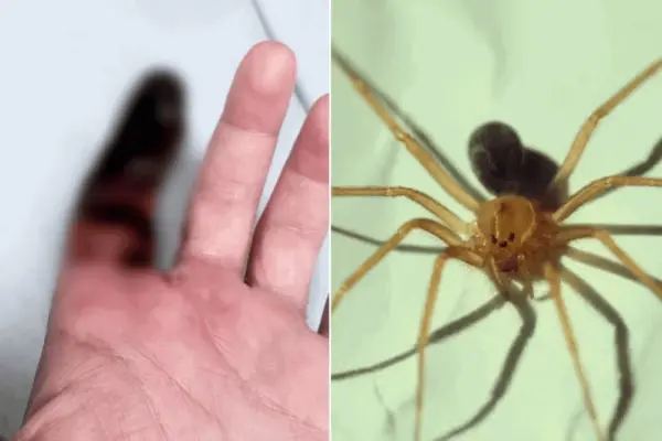 Homem picado por aranha venenosa enquanto dormia terá dedo amputado