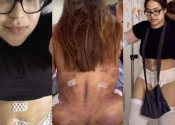 Influenciadora remove costelas em cirurgia, sofre 5 desmaios e choca ao mostrar hematomas no corpo: 'Cintura pequena'
© Instagram, Verolayne
