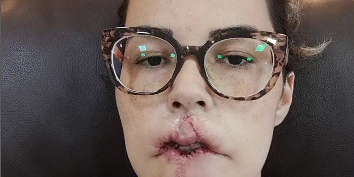 Mulher de óculos com cicatriz no lábio - Metrópoles - Foto: @mari_michelini/ Instagram