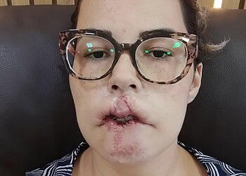 Mulher de óculos com cicatriz no lábio - Metrópoles - Foto: @mari_michelini/ Instagram